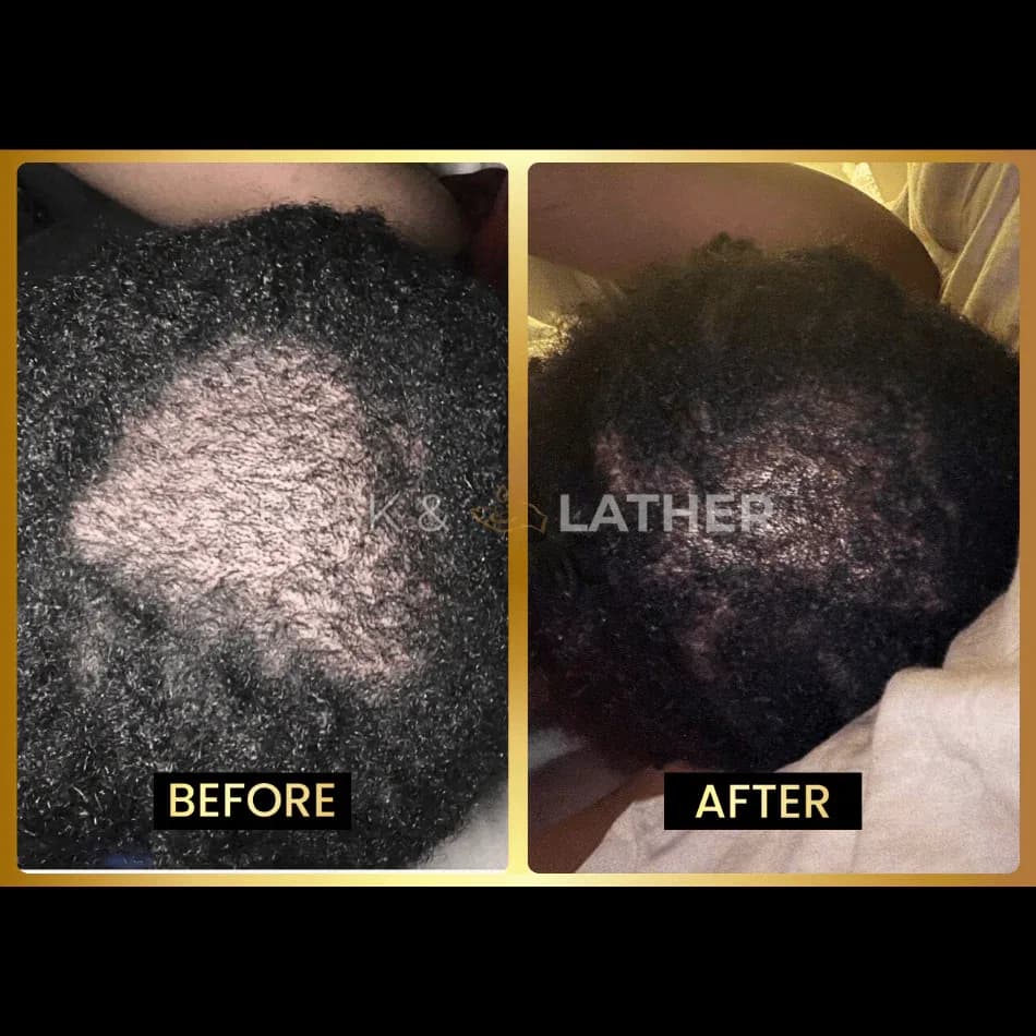 Scalp Stimulator - 3 Month Supply